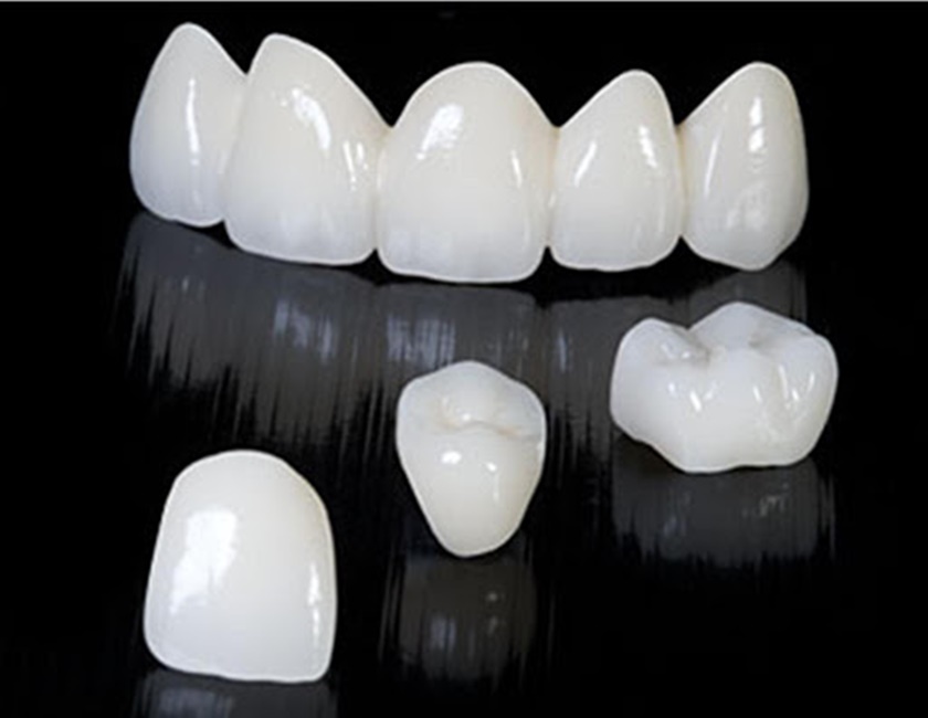Loại răng sứ Cercon có nhiều ưu điểm nổi bật so với những loại răng sứ khác