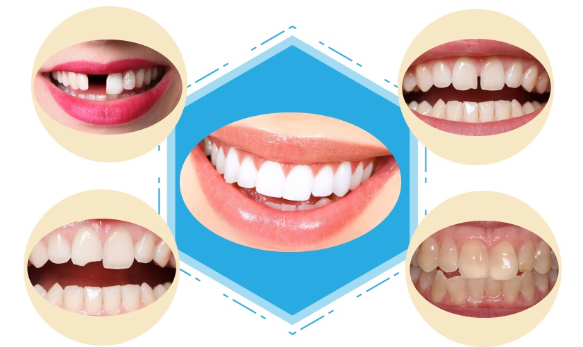 Chia sẻ kinh nghiệm bọc răng sứ Veneer và địa chỉ bọc răng sứ chất lượng