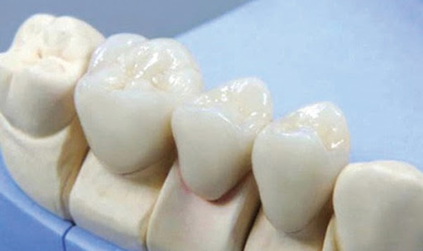  Hỏi: Răng toàn sứ tốt thế nào? Răng toàn sứ giá bao nhiêu?	