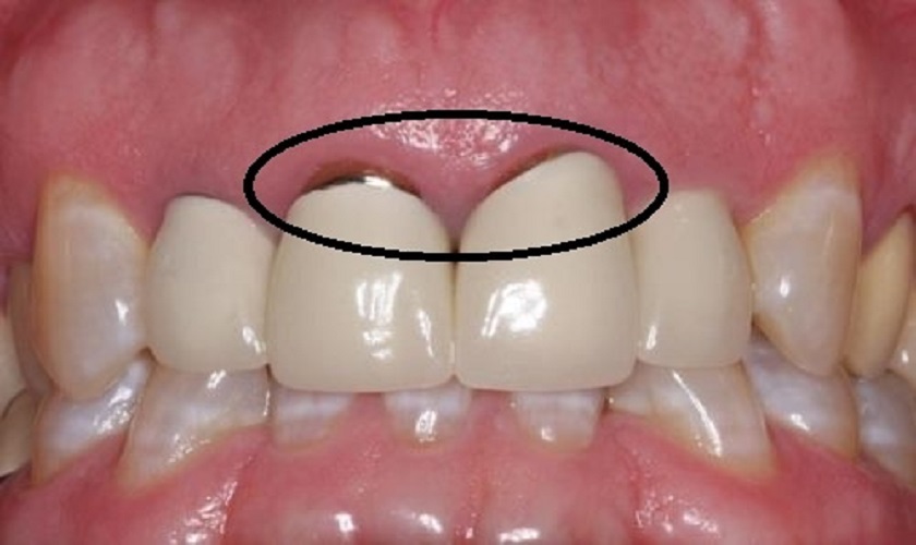  Nhược điểm của răng sứ Titan là gì? Dịch vụ làm răng sứ thẩm mỹ uy tín tại HCM ở đâu?