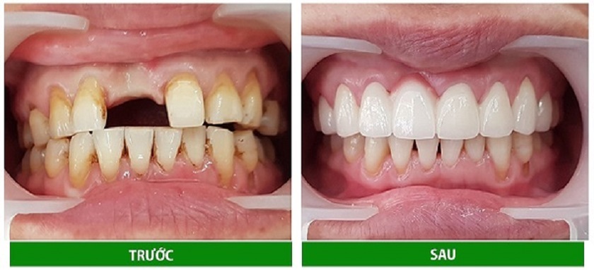 Chất lượng của răng sứ titan cũng rất tương xứng với số tiền bỏ ra