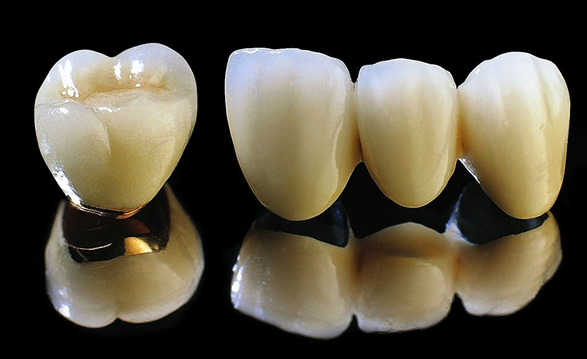 Thời gian bảo hành răng sứ tùy thuộc theo từng loại răng