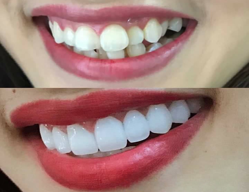 Tư vấn quy trình và nha khoa làm răng sứ thẩm mỹ tốt tại quận 10